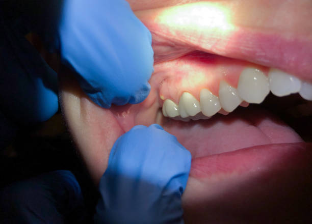 Best Tooth Infection Emergency Dentist  in Yuipa, CA