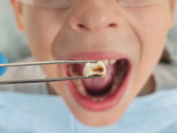 Best Broken Tooth Emergency  in Yuipa, CA